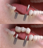 můstek nesený implantáty